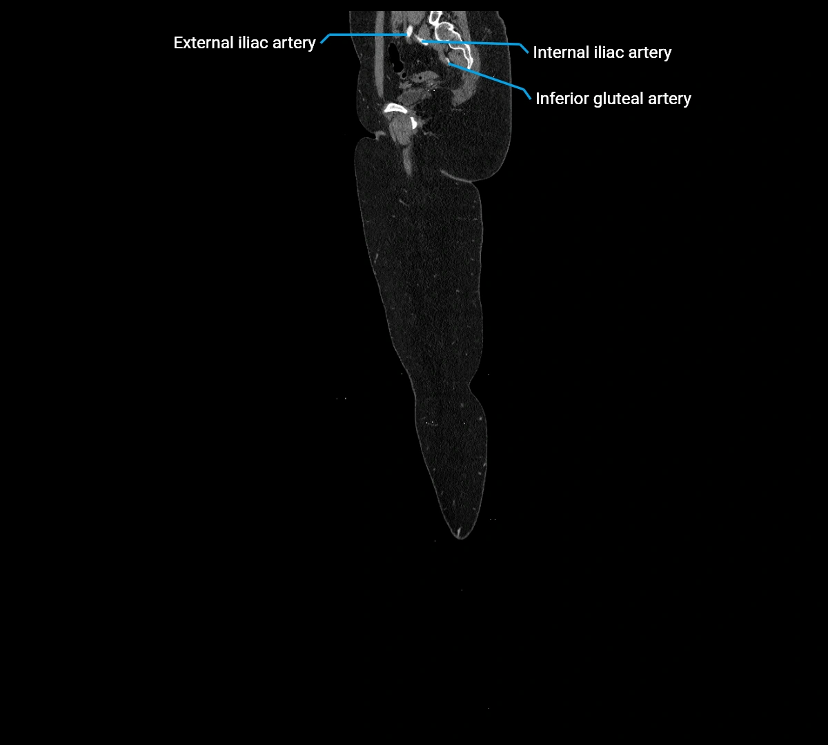 CTA lower limb sagittal cross sectional anatomy labelled image _9 (2).webp